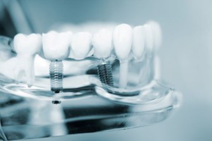 Dental model with two dental implants