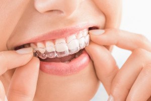 Close-up of woman’s mouth with Invisalign tray