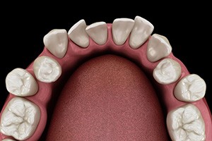 Illustration of crooked, crowded teeth viewed from above