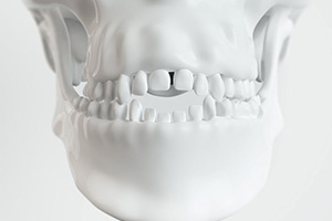 Illustration of human skull with open bite