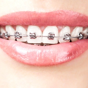 Traditional Braces Bloomfield, Orthodontics