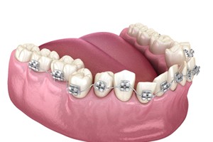 Traditional Braces  Wright and Feusier Orthodontics - Get Consultation!